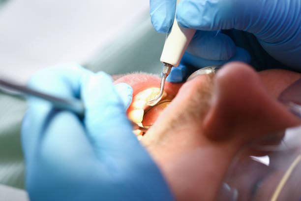 Best Urgent Care for Lost Fillings or Crowns in Crofton, MD